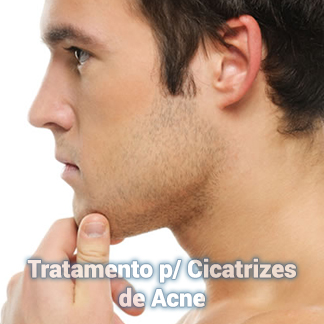 Tratamento p/ Cicatrizes de Acne Dermo Essence em Aracaju-SE