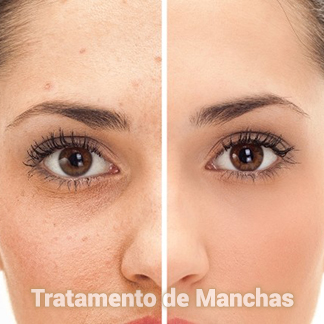 Tratamento de Manchas Dermo Essence em Aracaju-SE